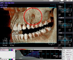 CT 3D画像