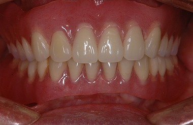 マグネット式義歯をご存知ですか？