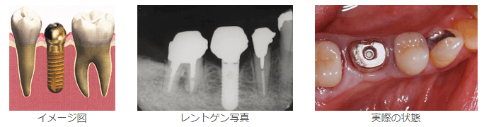 人工の土台の取り付け