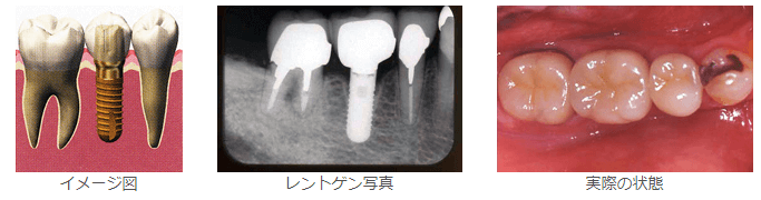 人工歯の取り付け