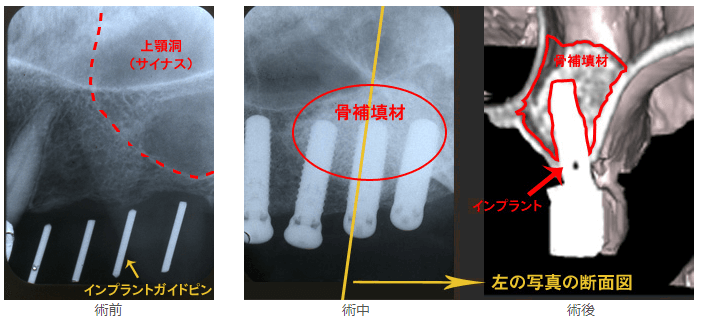 再生療法（サイナスリフト）