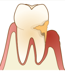 歯周病チェック