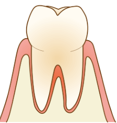 歯周病チェック